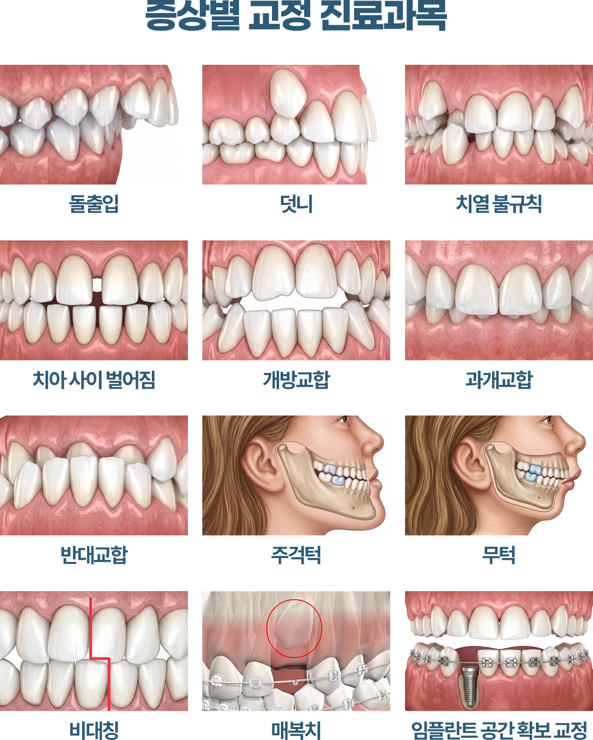 증상별 교정 진료과목 돌출입 덧니 치열 불규칙 치아사이벌어짐 개방교합 과개교합 반대교합 주걱턱 무턱 비대칭 매복치 임플란트공간확보교정