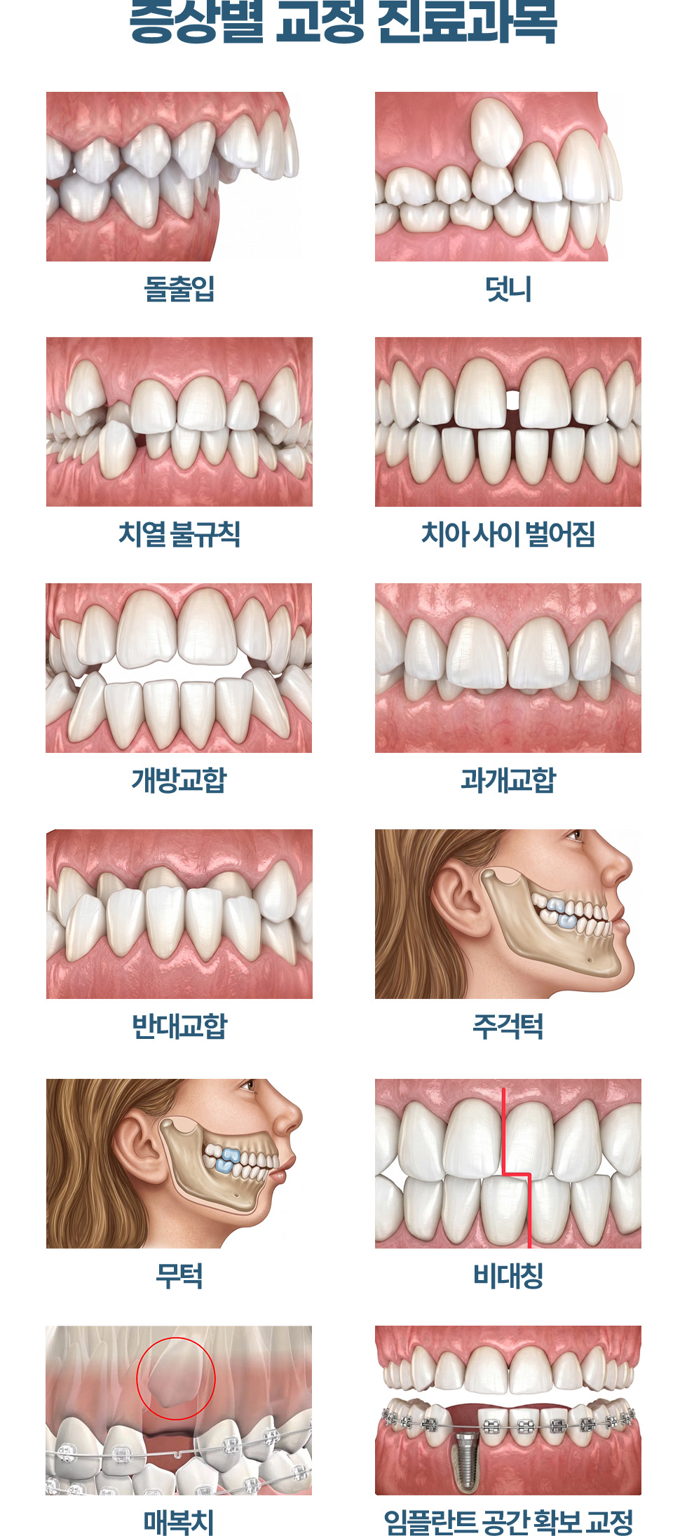 증상별 교정 진료과목 돌출입 덧니 치열 불규칙 치아사이벌어짐 개방교합 과개교합 반대교합 주걱턱 무턱 비대칭 매복치 임플란트공간확보교정